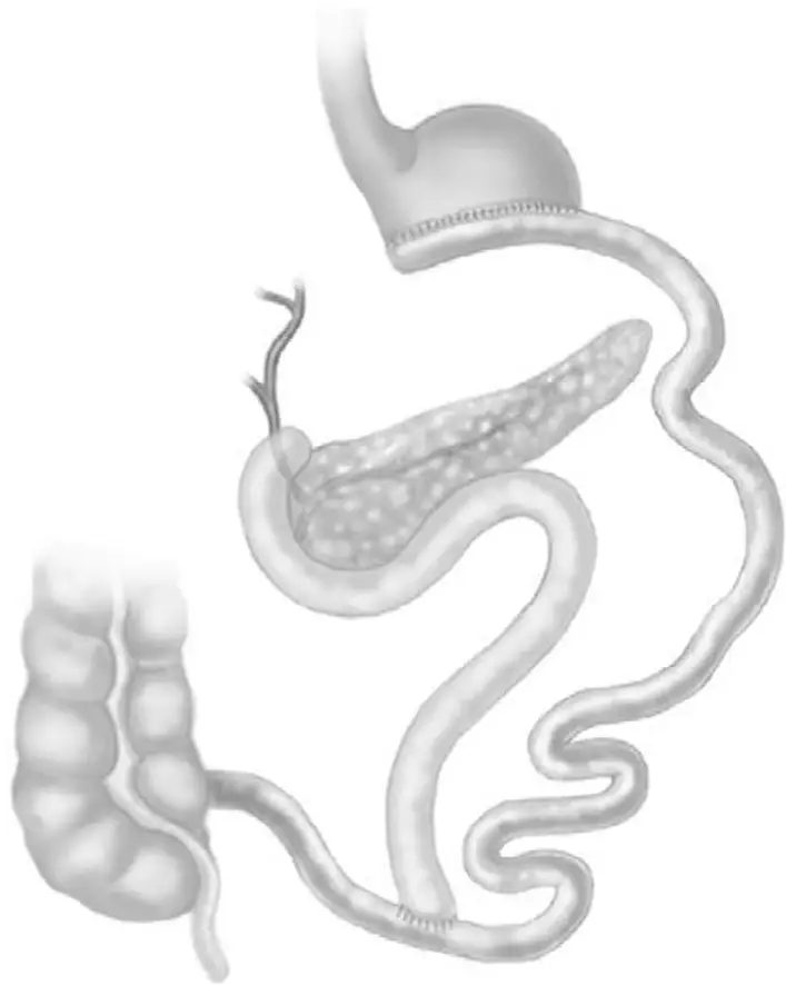Ch17-Fig3-biliopancreatic-diversion-with-duodenal-switch Ch17-Fig3-biliopancreatic-diversion-with-duodenal-switch
